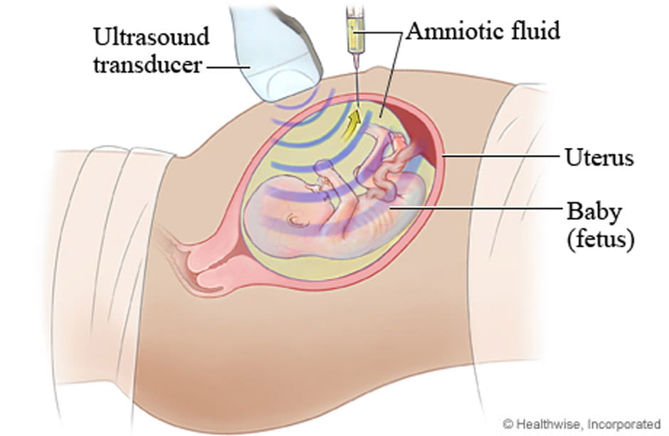 Illustration of a prenatal amniocentesis