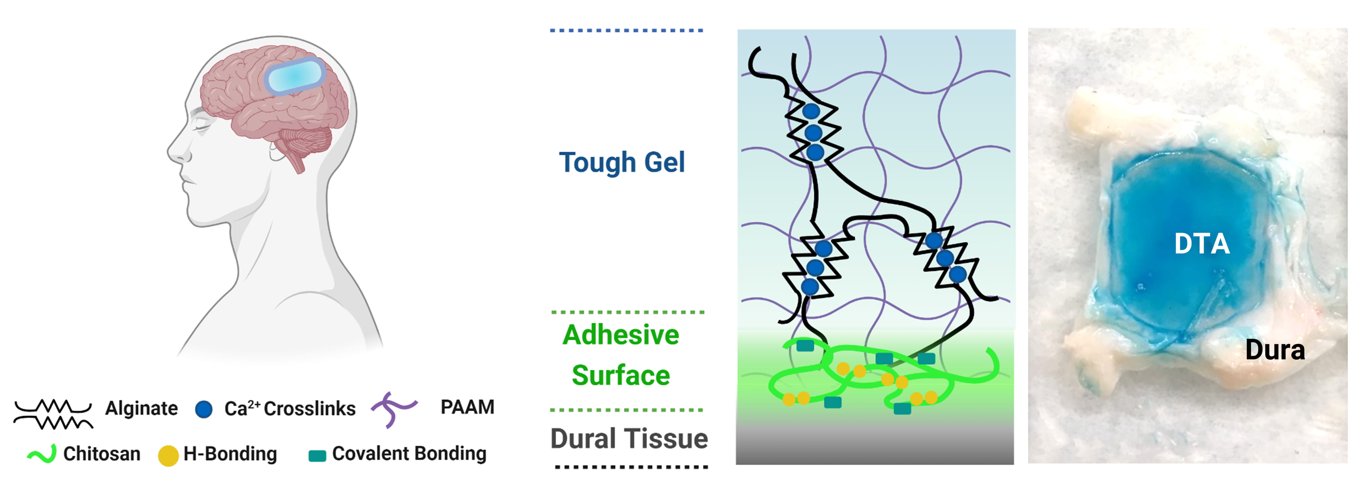 The Dural Tough Adhesive (DTA) consists of two intermixed polymer networks: a polyacrylamide network that is permanently crosslinked and provides high elasticity, and an alginate that is reversibly crosslinked and can redistribute the energy produced by mechanical forces in underlying tissues. Adding a highly adhesive layer to this Tough Gel that uses chitosan, a fibrous, sugar-based substance derived from the outer skeletons of shellfish, enables DTA to form multiple chemical interactions with tissues like the dura that create a tight seal. Credit: Wyss Institute at Harvard University