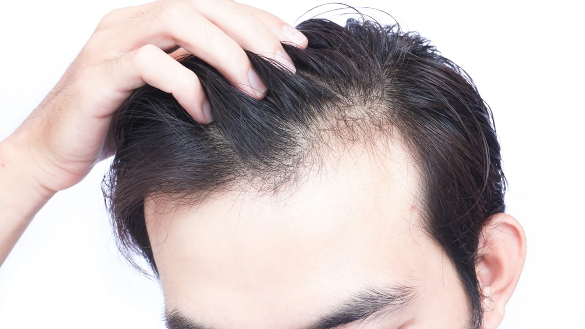Causes of Hair Loss - How to Stop Hair Loss for Men