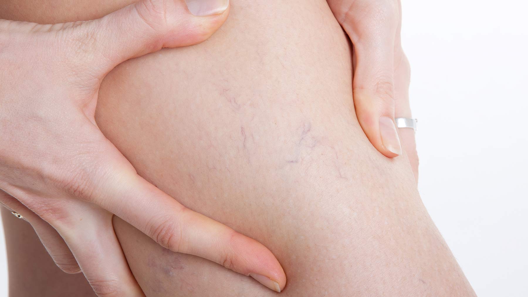 Learn the difference between spider veins and varicose veins