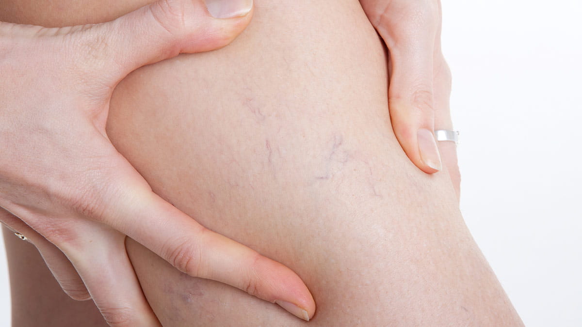 Are Spider Veins a Health Concern? - Vein Health Clinics