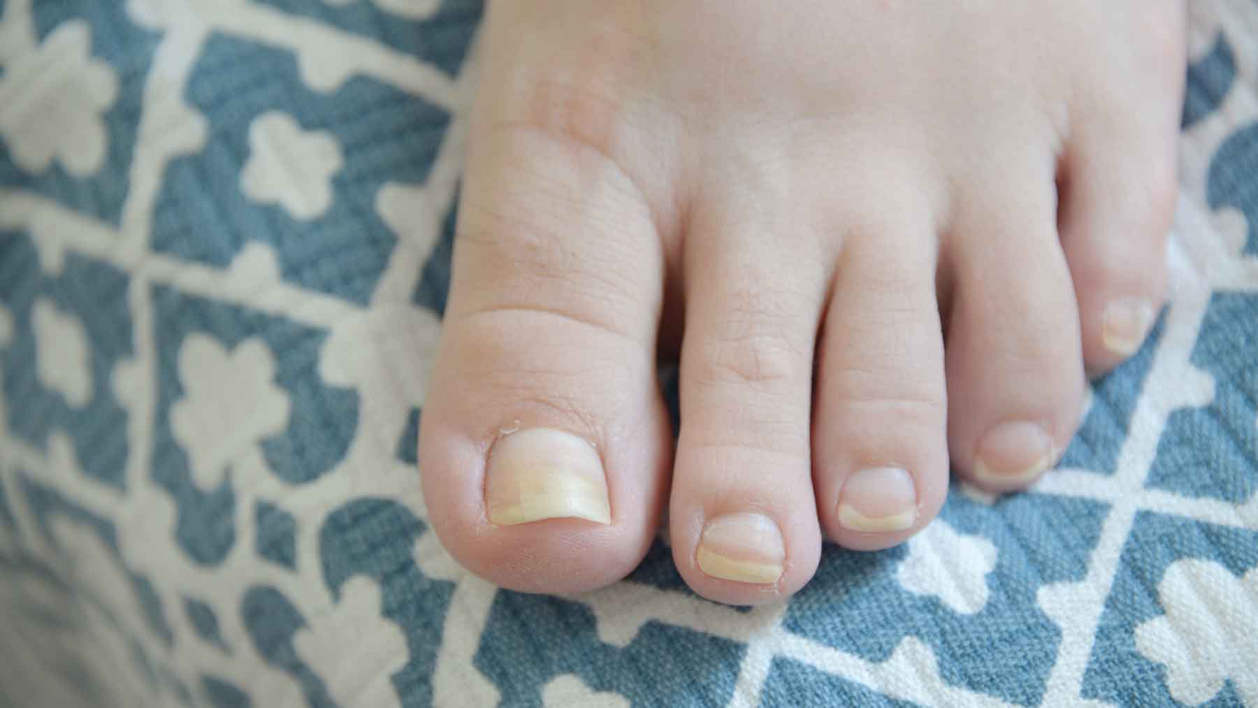 Nail Abnormalities: Symptoms, Causes, and Prevention