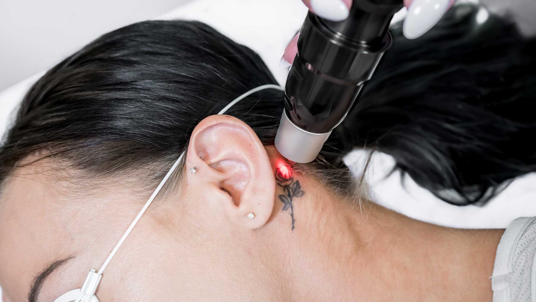 Victory Cincinnati has the LATEST tattoo removal laser. Super effective and  gets rid of LARGE tattoos faste… | Laser tattoo removal, Tattoo removal,  Laser treatment