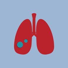 Lung icon depicting interventional pulmonology