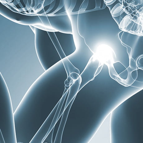 Bones of the hip with joint pain