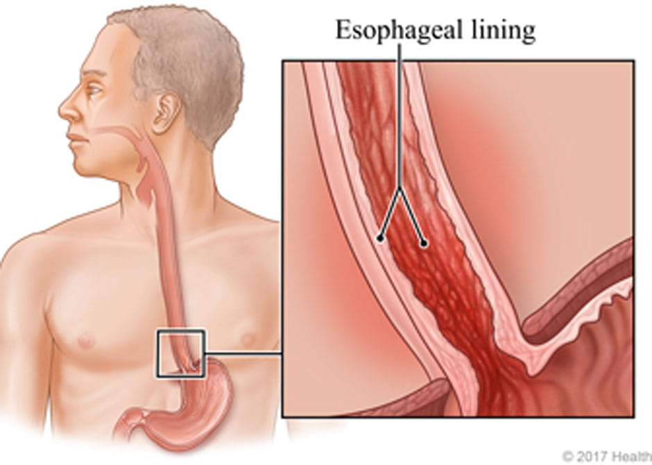 EosinophilicEsophagitis