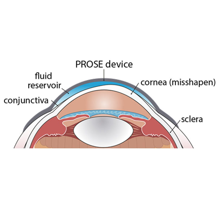 Diagram of eye shape with PROSE device
