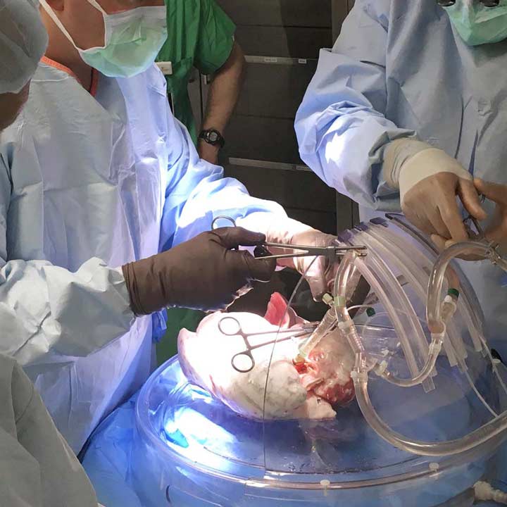 Ex-Vivo-lung-operation