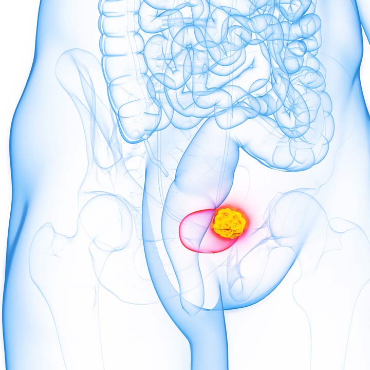 bladder-cancer-illustration
