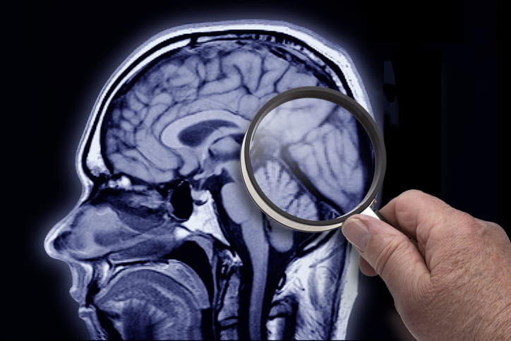 No single test can confirm the diagnosis of dimentia, so we’ll use various tools to help us including MRI brain scans.