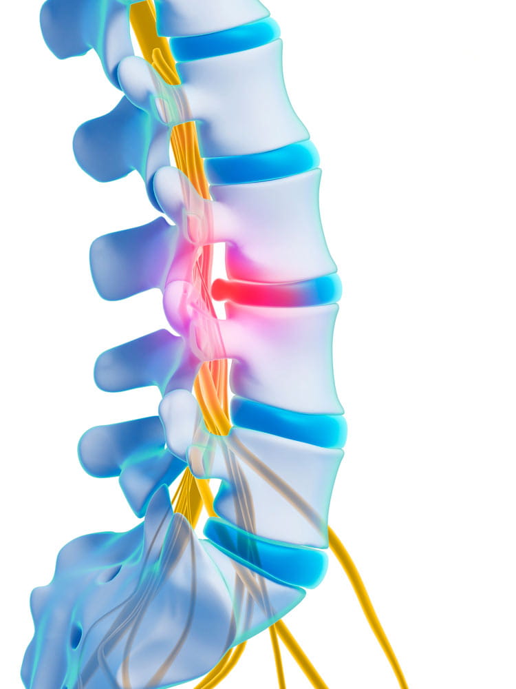 An illustration showing a herniated disc in the spine