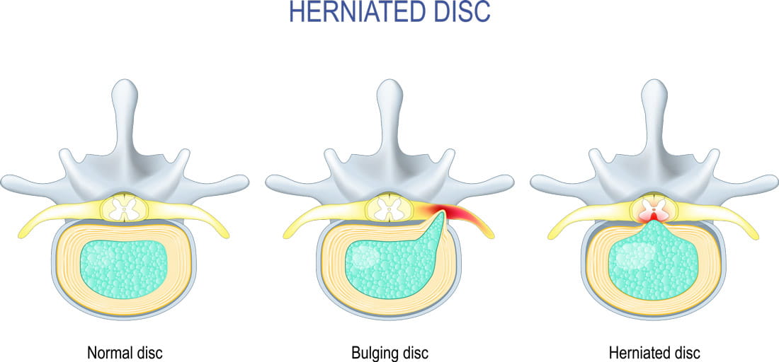 Illustration of herniated disc