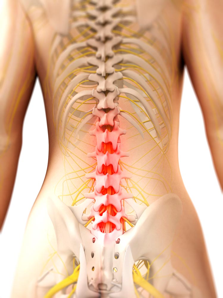 Pinched Nerve Treatment - Neck & Arm Pain Therapy