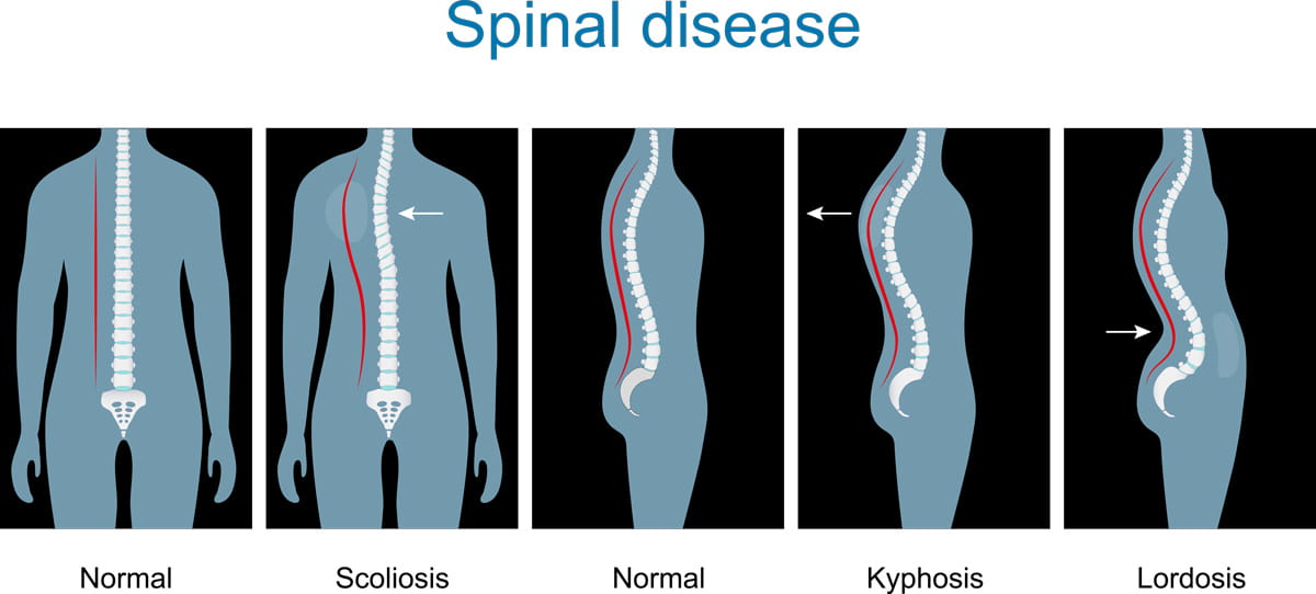 Spinal Curvature (Scoliosis, Kyphosis and Lordosis) | Ohio State ...