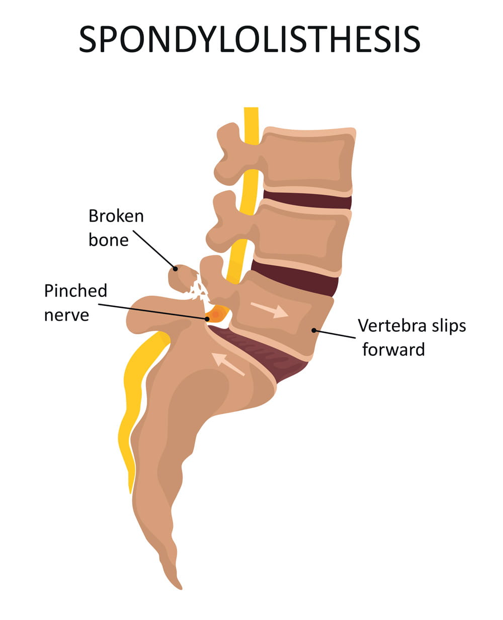 An illustration showing spondylolisthesis in the spine