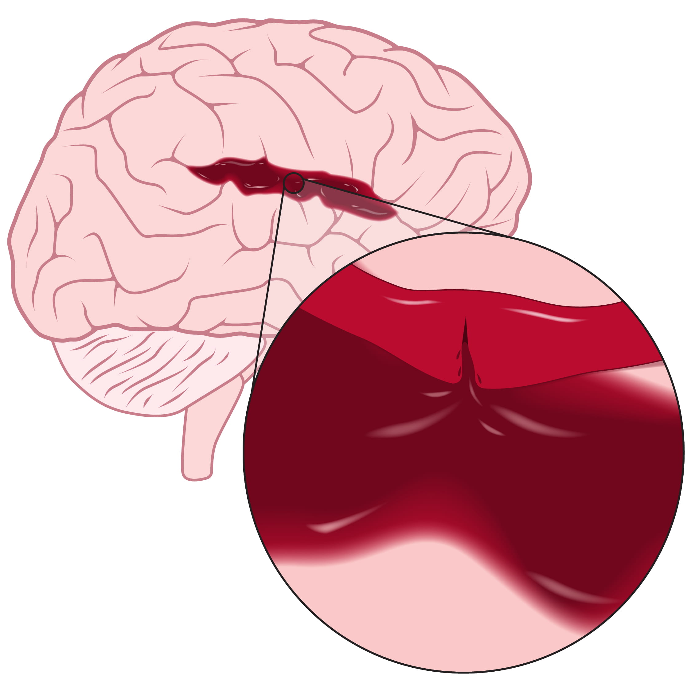 Hemorrhagic stroke illustration