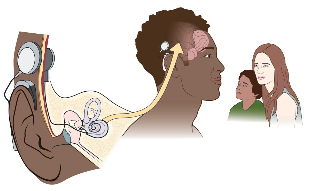 Cochlear Implant Illustration