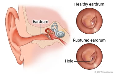 ruptured eardrum drainage