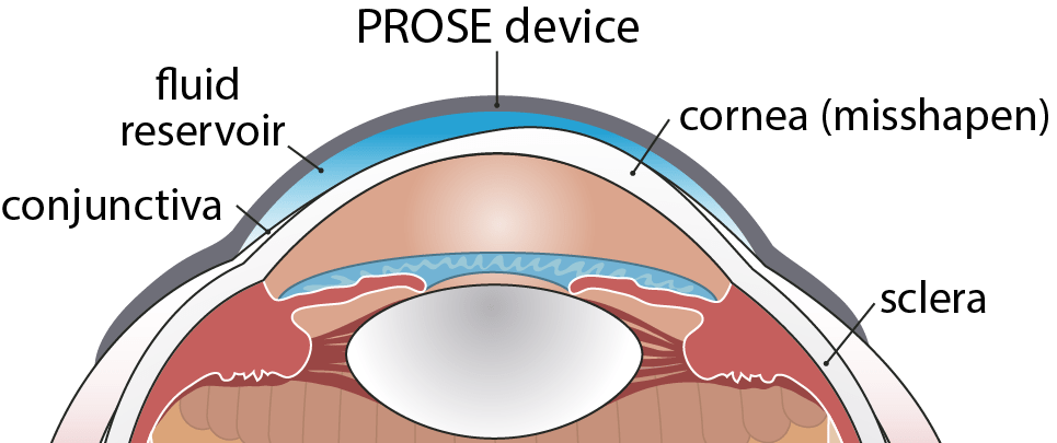 Diagram of the eye and PROSE device