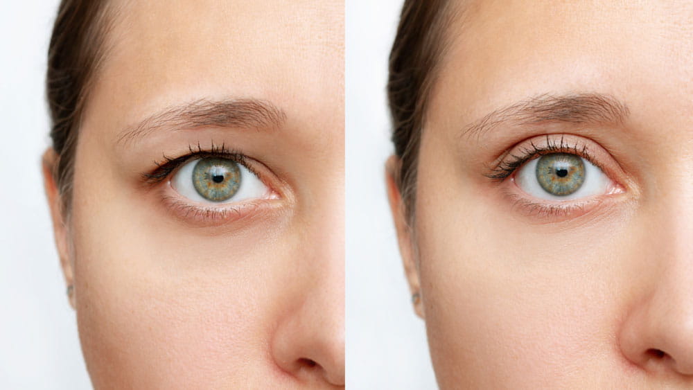 A woman with droopy eyelids comparison before and after surgery