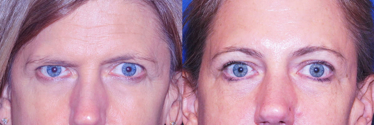 Endoscopic browlift before and after