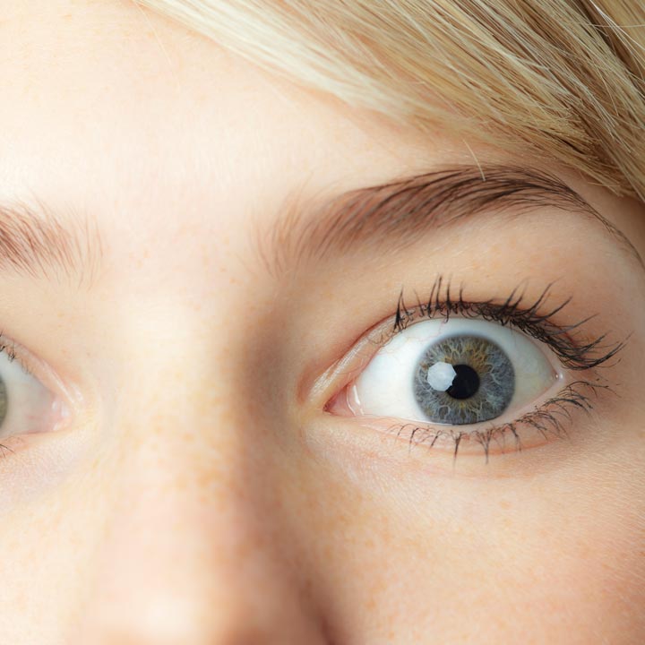 Woman with thyroid eye disease, big eyes