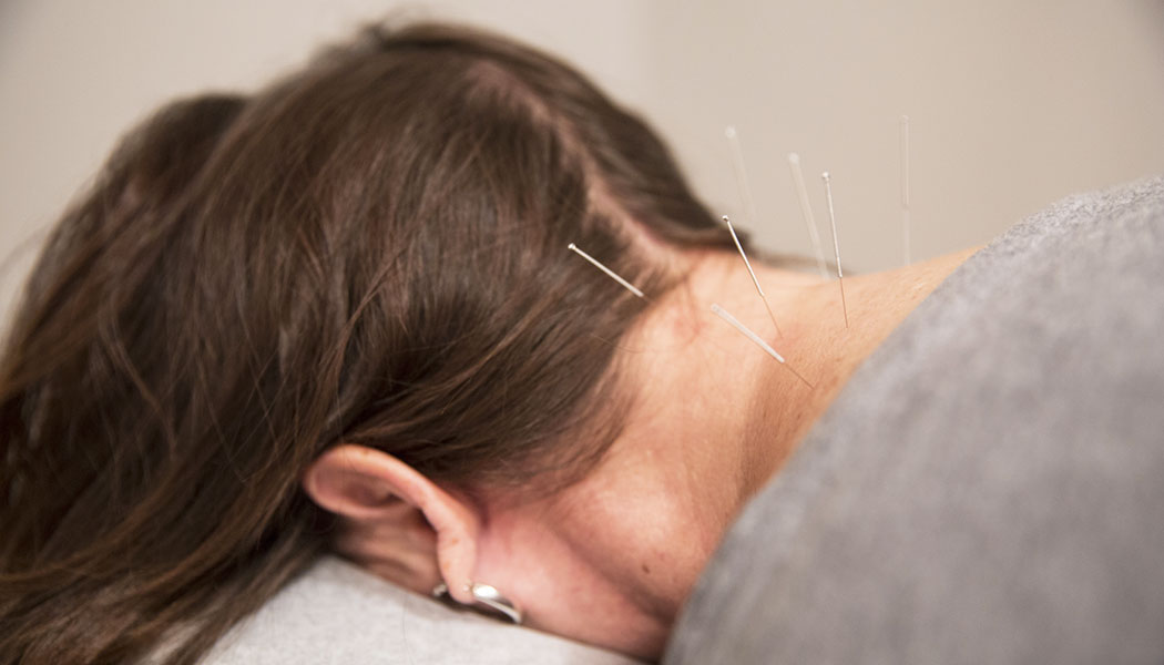 Acupuncture | Ohio State Integrative Medicine