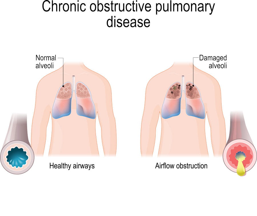 Bronchoscopic Lung Volume Reduction (BLVR) Treatment Ohio State