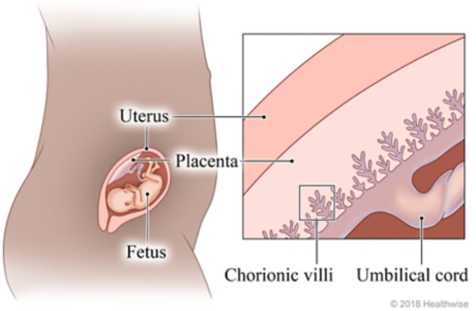 Chorionic Villus Sampling I Ohio State Obstetrics Gynecology