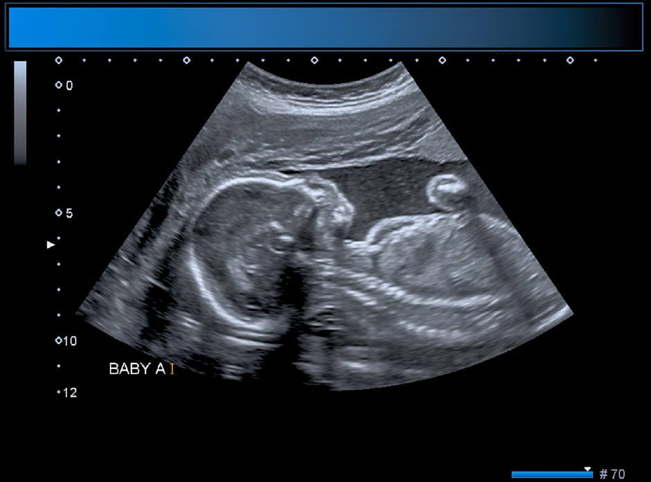 Ultrasound photo of baby