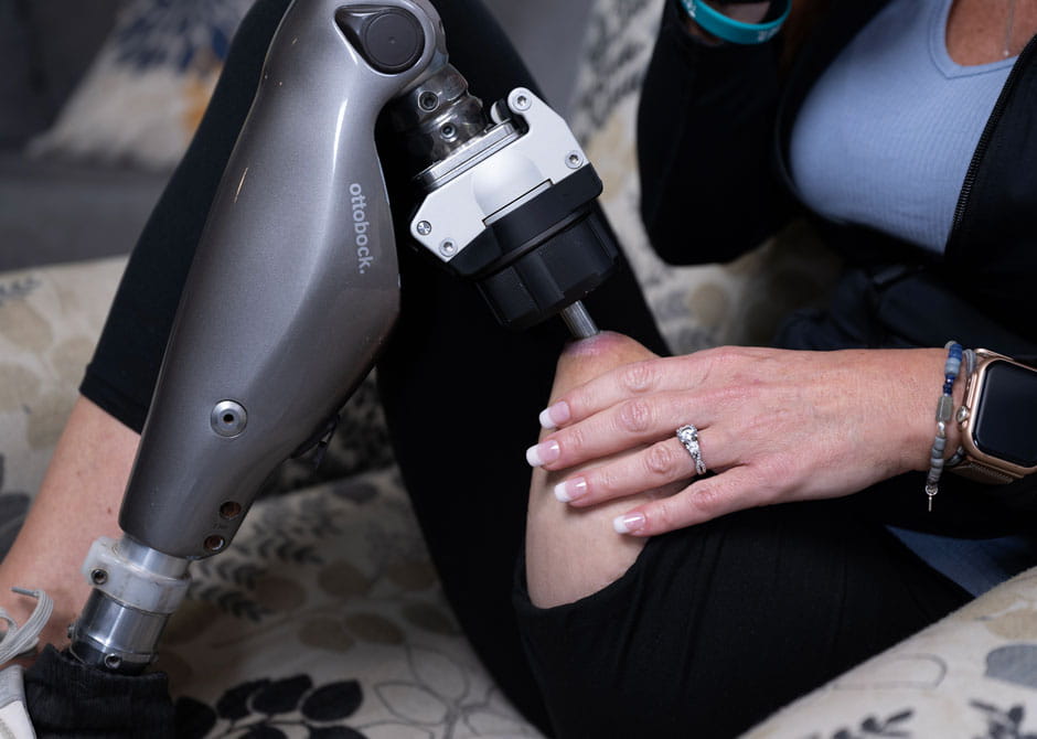 patient Stacey Finley with prosthetic leg