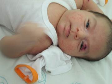 Syrian refugee baby with Cutaneous Leishmaniasis